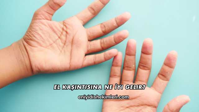 El Kaşıntısına Ne İyi Gelir?