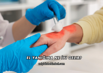 El Yanığına Ne İyi Gelir?