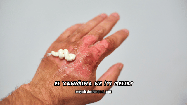 El Yanığına Ne İyi Gelir?