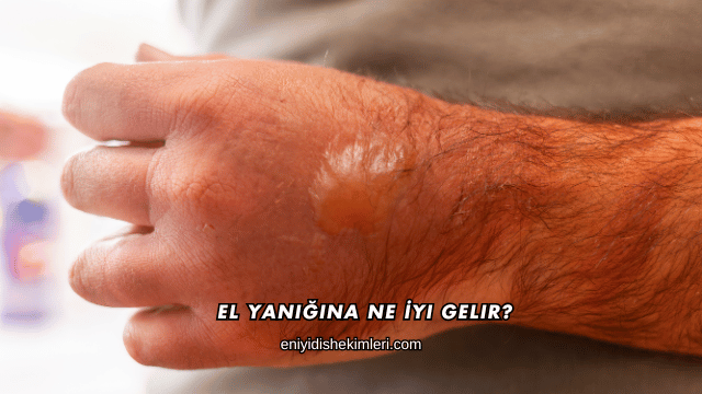 El Yanığına Ne İyi Gelir?