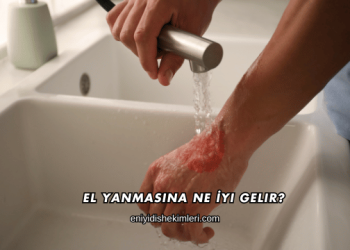 El Yanmasına Ne İyi Gelir?