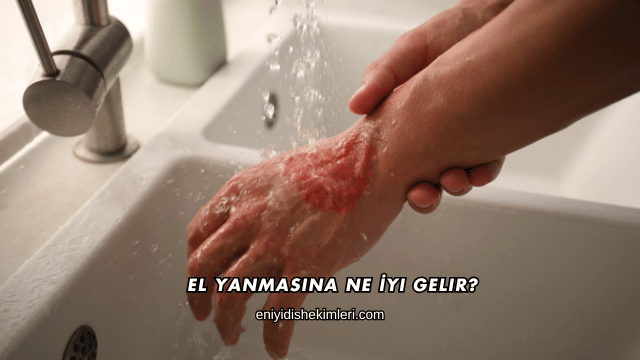 El Yanmasına Ne İyi Gelir?