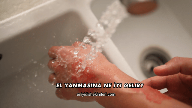 El Yanmasına Ne İyi Gelir?