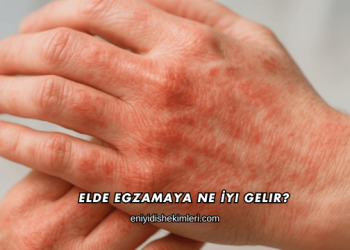 Elde Egzamaya Ne İyi Gelir?