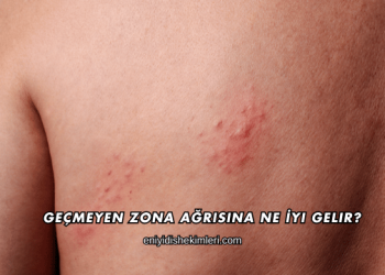 Geçmeyen Zona Ağrısına Ne İyi Gelir?