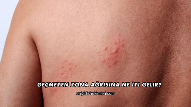 Geçmeyen Zona Ağrısına Ne İyi Gelir?