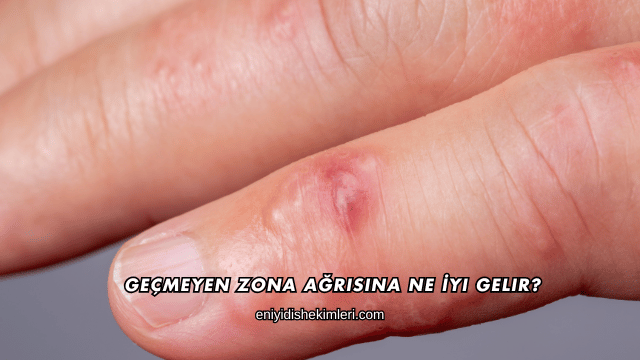 Geçmeyen Zona Ağrısına Ne İyi Gelir?