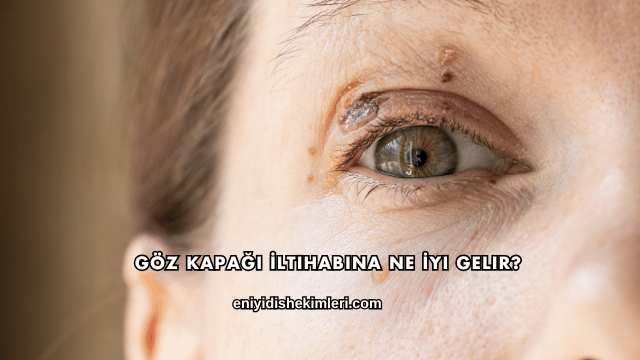 Göz Kapağı İltihabına Ne İyi Gelir?