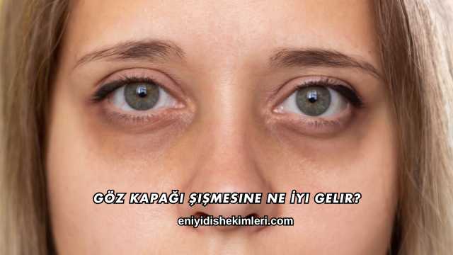 Göz Kapağı Şişmesine Ne İyi Gelir?