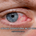 Gözdeki Enfeksiyona Ne İyi Gelir?