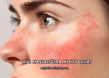 Gül Hastalığına Ne İyi Gelir?