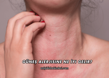 Güneş Alerjisine Ne İyi Gelir?