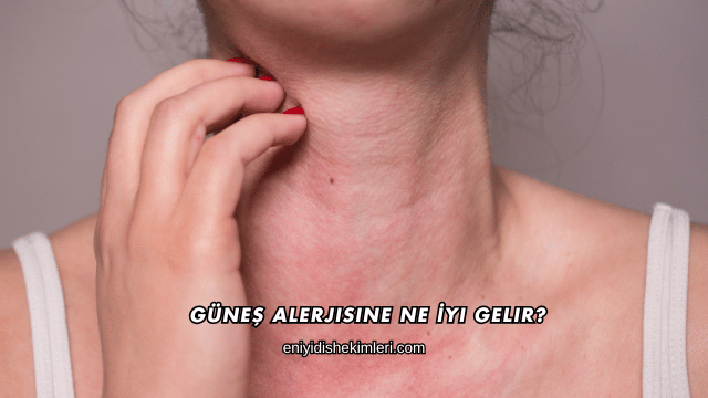 Güneş Alerjisine Ne İyi Gelir?