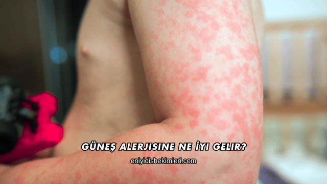 Güneş Alerjisine Ne İyi Gelir?