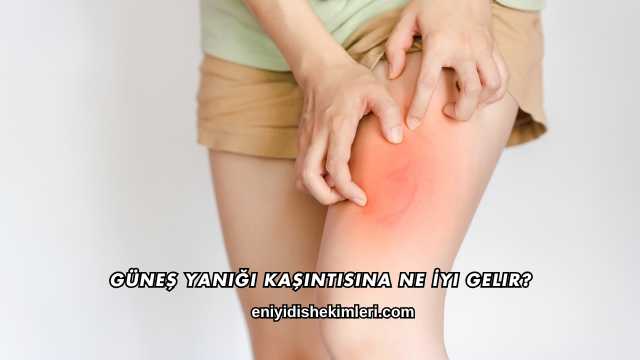 Güneş Yanığı Kaşıntısına Ne İyi Gelir?