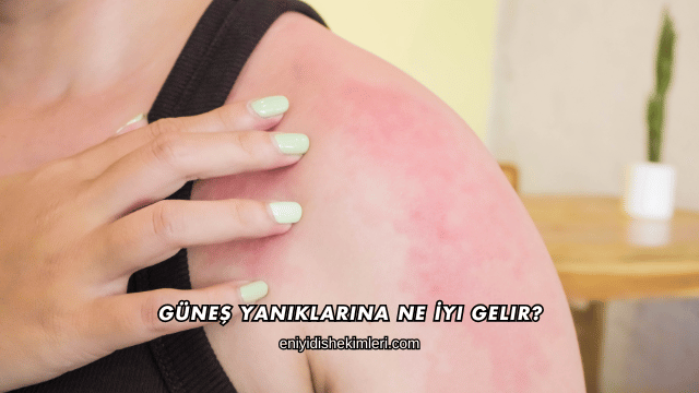 Güneş Yanıklarına Ne İyi Gelir?