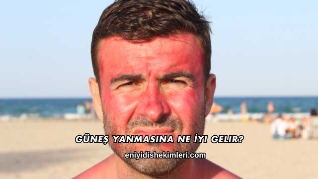 Güneş Yanmasına Ne İyi Gelir?
