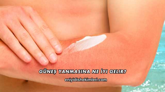 Güneş Yanmasına Ne İyi Gelir?