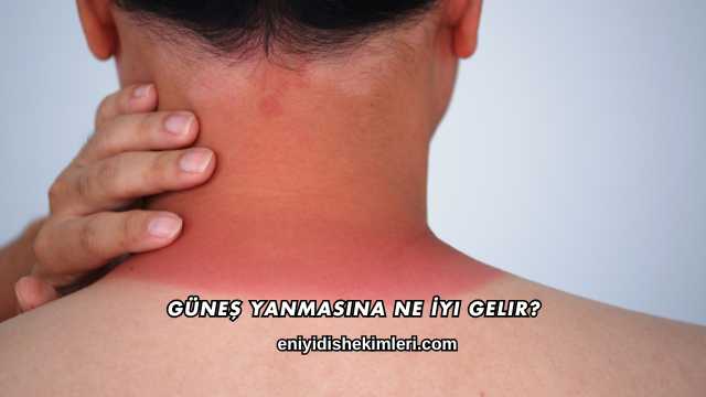 Güneş Yanmasına Ne İyi Gelir?