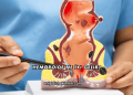 Hemoroide Ne İyi Gelir?