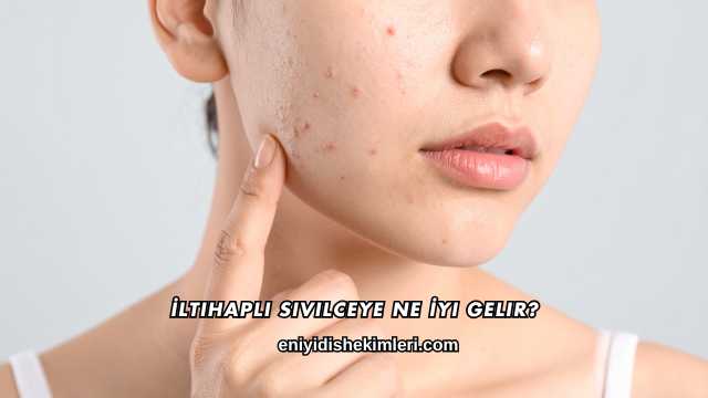 İltihaplı Sivilceye Ne İyi Gelir?