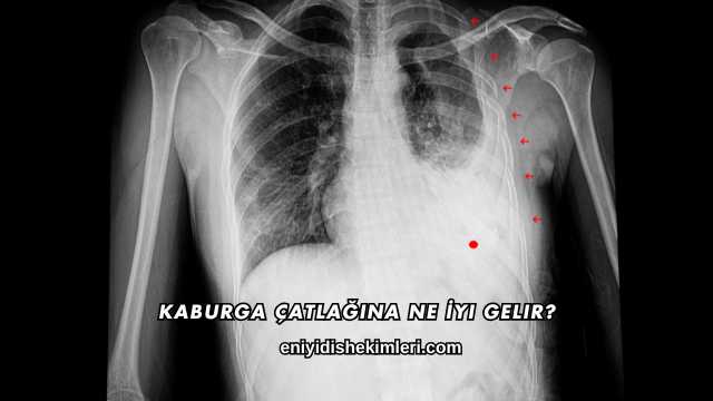 Kaburga Çatlağına Ne İyi Gelir?