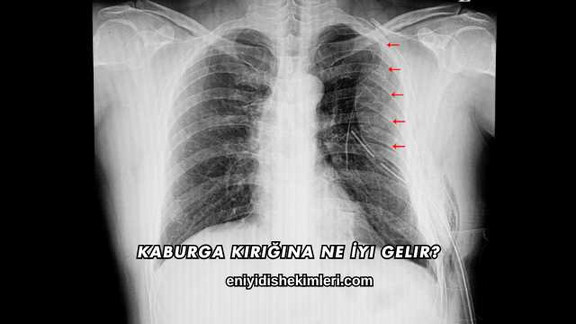 Kaburga Kırığına Ne İyi Gelir?