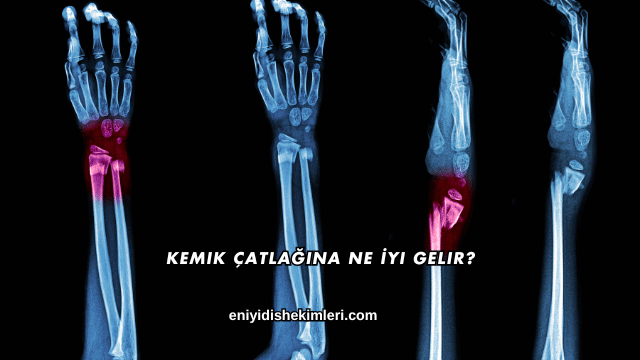 Kemik Çatlağına Ne İyi Gelir?