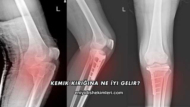 Kemik Kırığına Ne İyi Gelir?