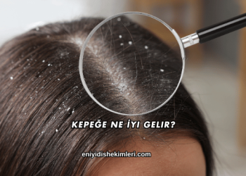 Kepeğe Ne İyi Gelir?