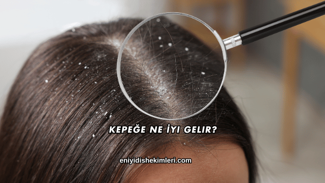 Kepeğe Ne İyi Gelir?