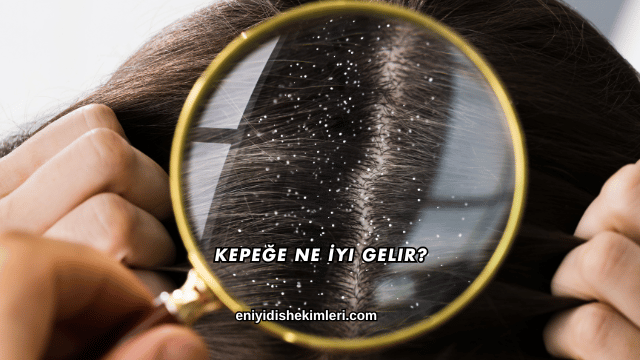 Kepeğe Ne İyi Gelir?