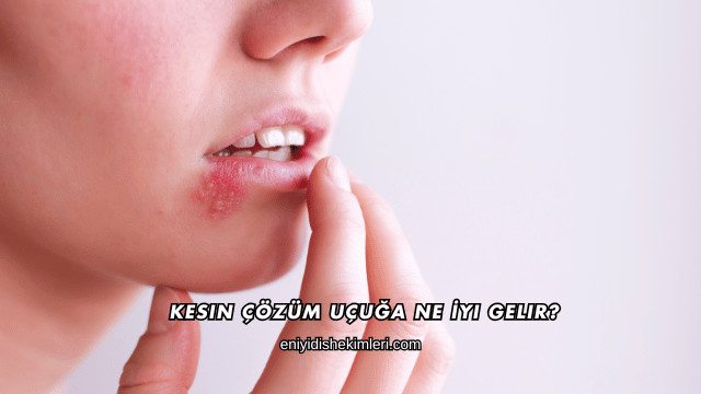 Kesin Çözüm Uçuğa Ne İyi Gelir?