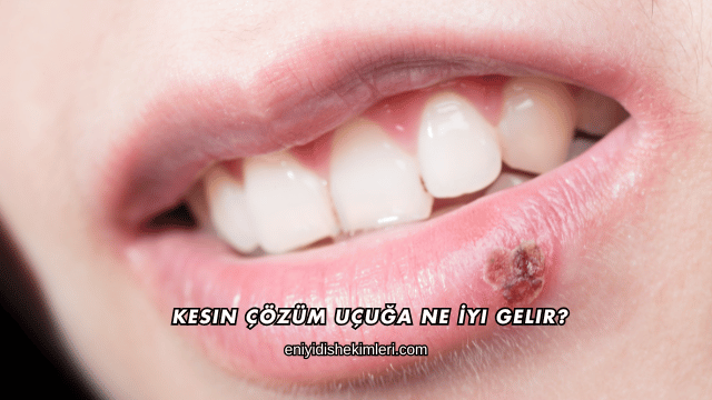 Kesin Çözüm Uçuğa Ne İyi Gelir?