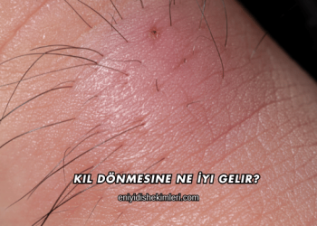 Kıl Dönmesine Ne İyi Gelir?