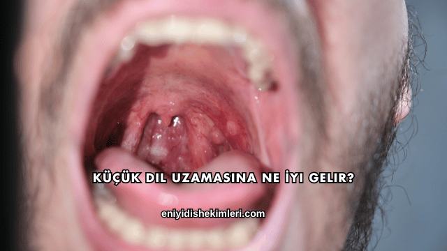 Küçük Dil Uzamasına Ne İyi Gelir?