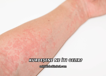 Kurdeşene Ne İyi Gelir?