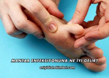 Mantar Enfeksiyonuna Ne İyi Gelir?
