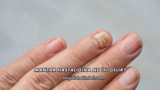 Mantar Hastalığına Ne İyi Gelir?