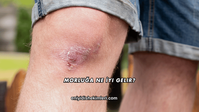 Morluğa Ne İyi Gelir?