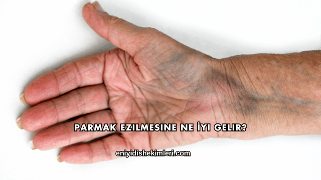 Parmak Ezilmesine Ne İyi Gelir?