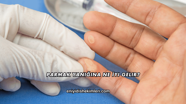 Parmak Yanığına Ne İyi Gelir?