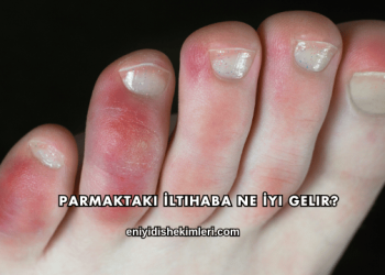 Parmaktaki İltihaba Ne İyi Gelir?