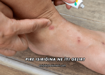 Pire Isırığına Ne İyi Gelir?