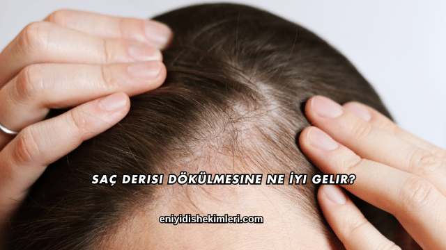Saç Derisi Dökülmesine Ne İyi Gelir?