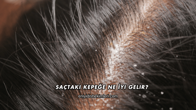 Saçtaki Kepeğe Ne İyi Gelir?