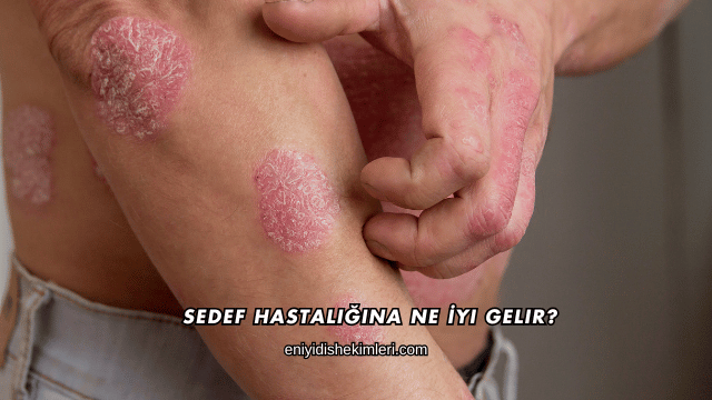 Sedef Hastalığına Ne İyi Gelir?