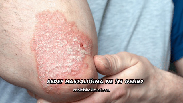 Sedef Hastalığına Ne İyi Gelir?