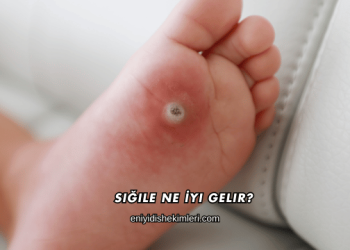 Siğile Ne İyi Gelir?
