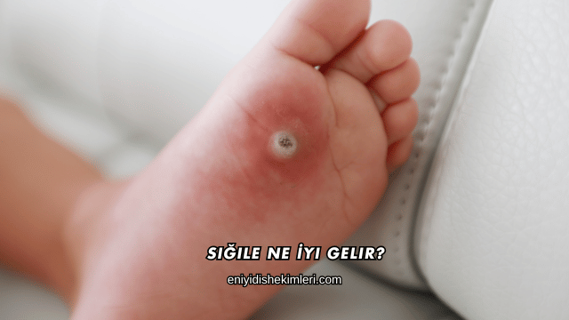 Siğile Ne İyi Gelir?